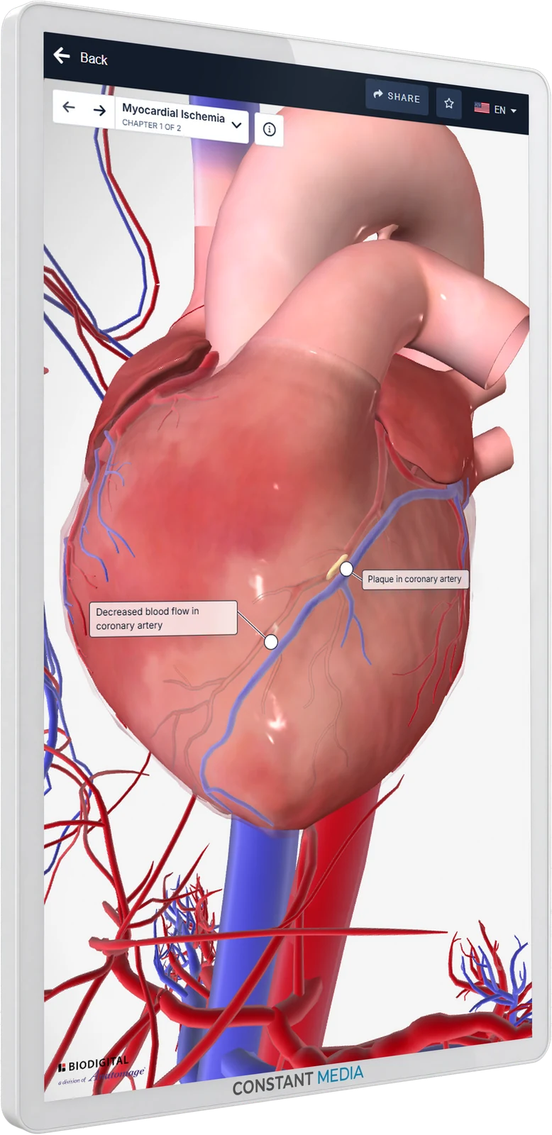 Constant Media interactive exam room wallboard showing a 3D heart model with labeled areas of myocardial ischemia
